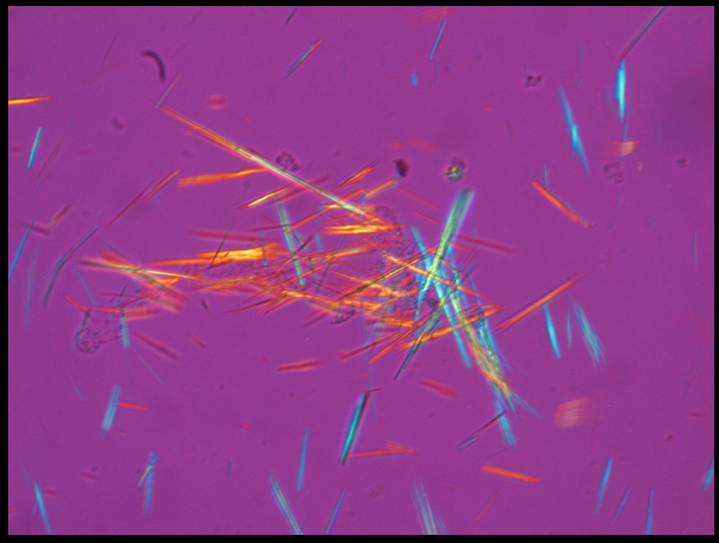 Monosodium urate crystals under polarized light